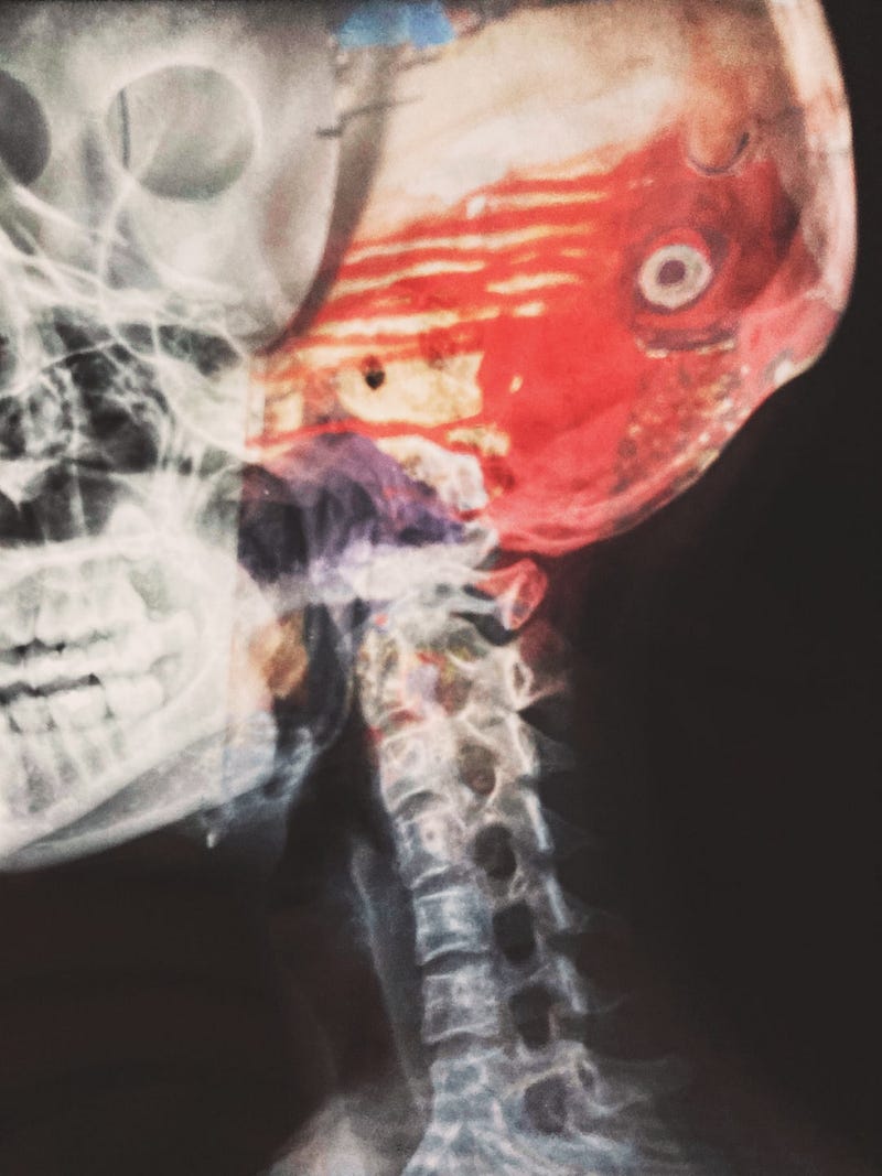 Neuralink's brain-computer interface device